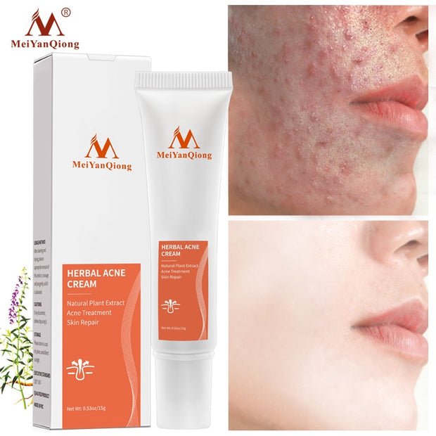 Acne Cream Eliminate Marks Repair Damaged Skin Moisturizing Nourishing Face Care