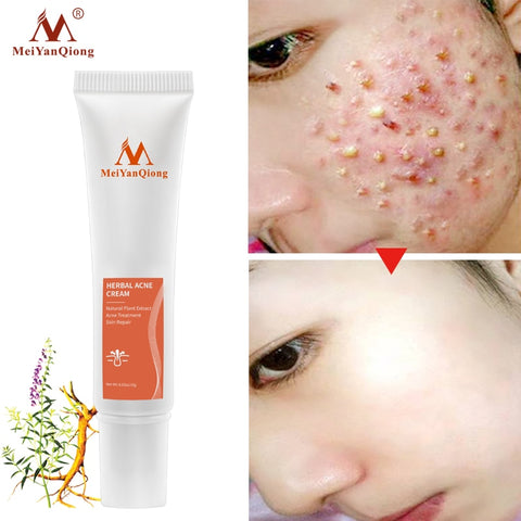 Acne Cream Eliminate Marks Repair Damaged Skin Moisturizing Nourishing Face Care